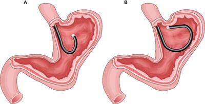 A novel technique for endoscope progression in gastroscopy resection: forward-return way for dissection of stromal tumor in the muscularis propria of the gastric fundus